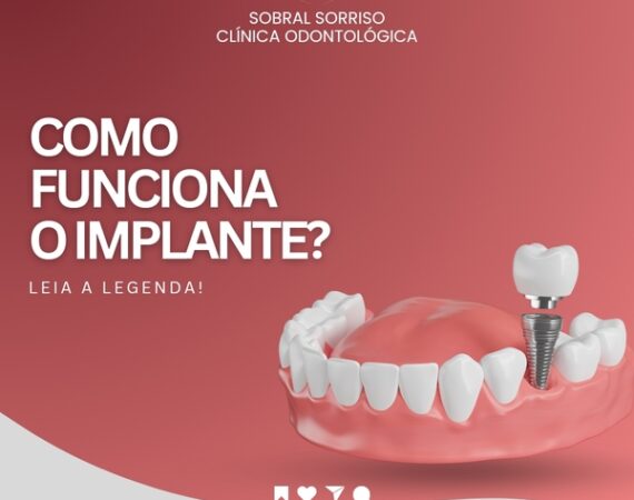 Implantes